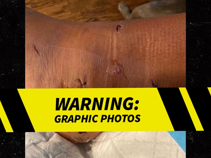 Meg Thee Stallion's Gunshot Wound in Foot