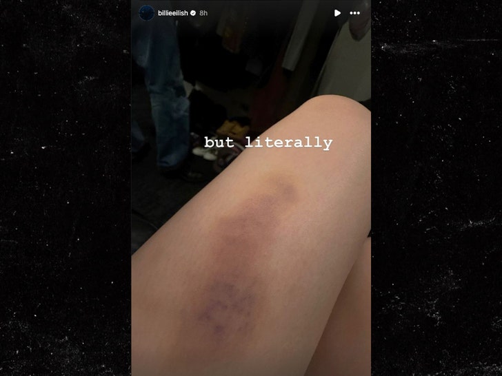 Billie Eilish with bruise on her leg